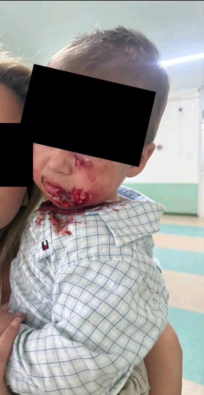 дете каснато од куче скитник во Битола фото Апла.мк